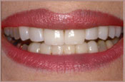 veneers-a.jpg