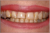 veneers-b.jpg